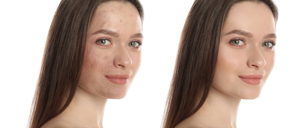 Chemical Peel before and after — Case 01 · Tone & clarity