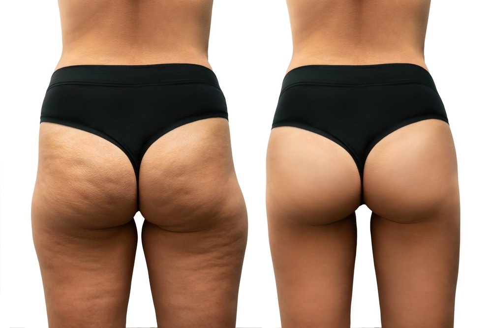 Endosphères Classic before and after — Case 01 · Thighs & glutes