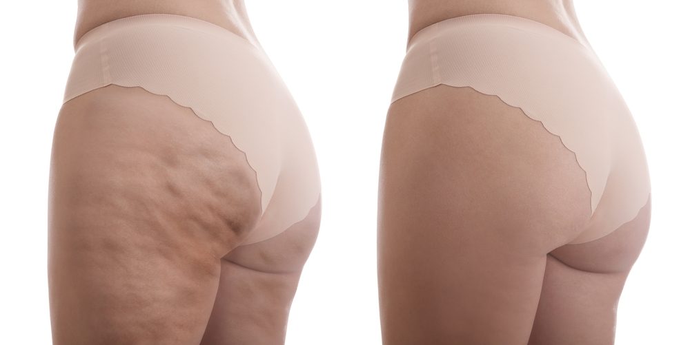 Endosphères Evolution before and after — Case 01 · Thighs & glutes