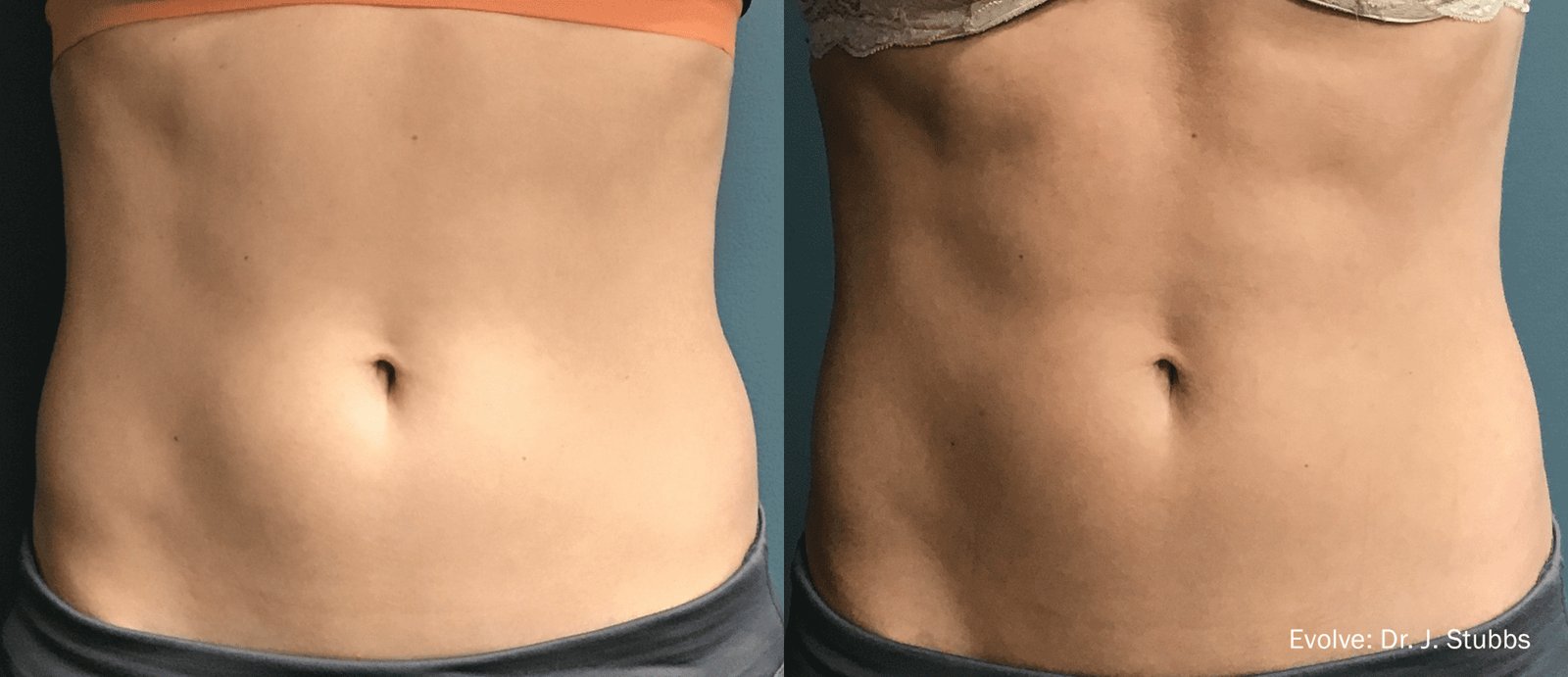 EvolveX before and after — Case 01 · Abdomen