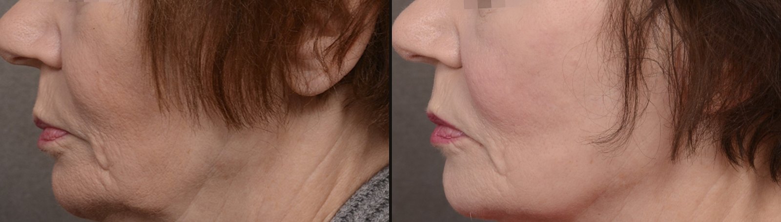 Forma before and after — Case 01 · Jawline & neck