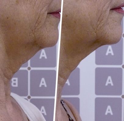 Icoone® before and after — Case 02 · Icoone® facial