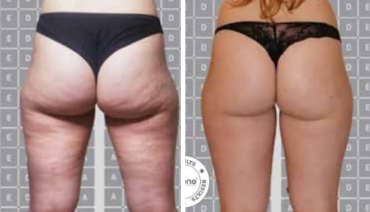 Icoone® before and after — Case 01 · Icoone® course