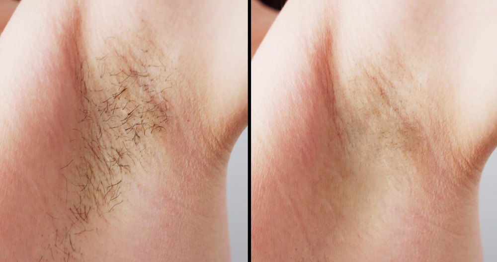 Laser Hair Removal before and after — Case 01 · Underarm
