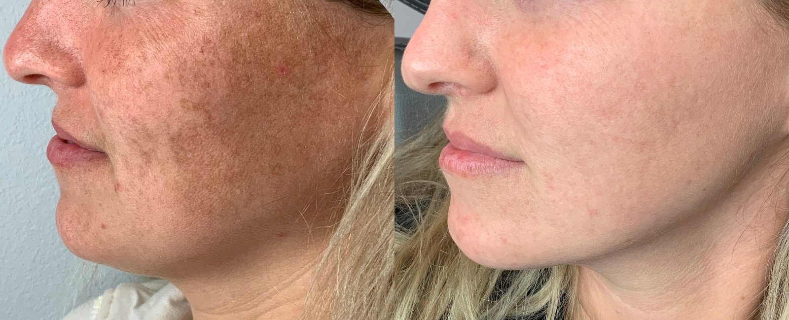 Lumecca before and after — Case 01 · Sun damage & pigment