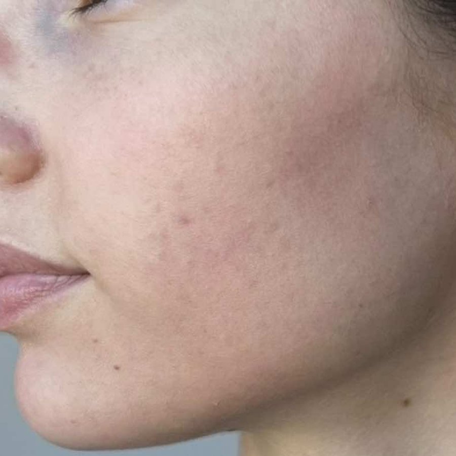 Microneedling after — Case 01 · Acne & texture