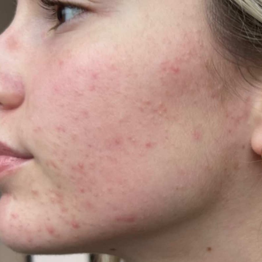 Microneedling before — Case 01 · Acne & texture