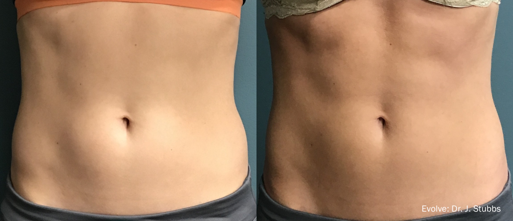 EvolveX before and after body contouring results